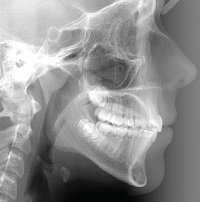 Jaw pain, TMJ, TMD and headaches