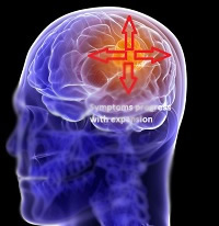 Brain and Nerve Tumours leading to Headache or Migraine